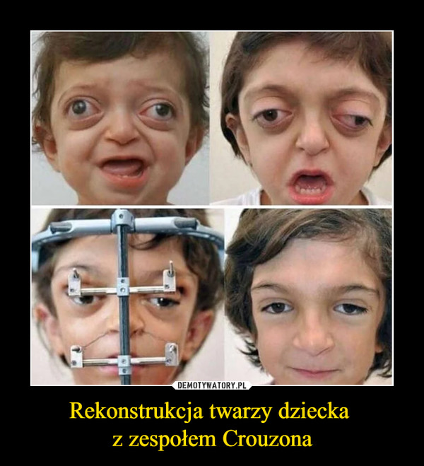 Rekonstrukcja twarzy dziecka 
z zespołem Crouzona