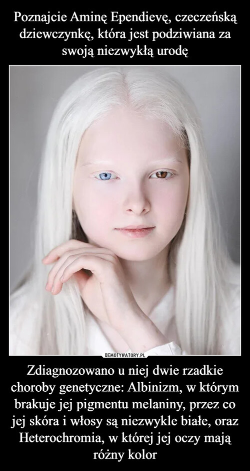 Poznajcie Aminę Ependievę, czeczeńską dziewczynkę, która jest podziwiana za swoją niezwykłą urodę Zdiagnozowano u niej dwie rzadkie choroby genetyczne: Albinizm, w którym brakuje jej pigmentu melaniny, przez co jej skóra i włosy są niezwykle białe, oraz Heterochromia, w której jej oczy mają różny kolor